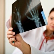 Osteoporosis  related image